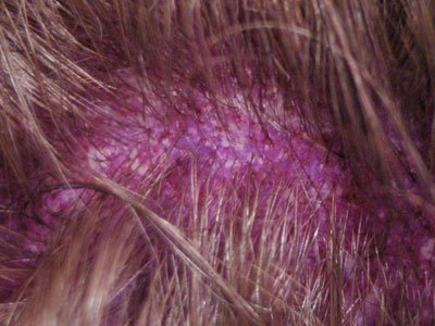 purpleScalp.jpg